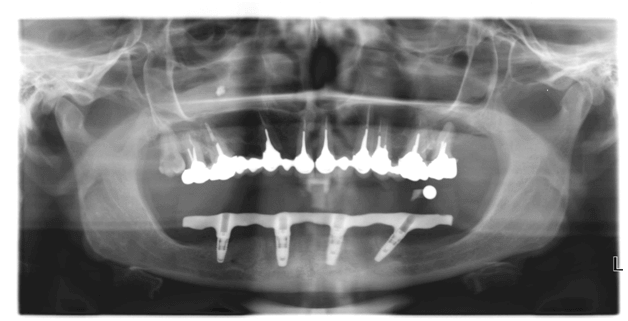 шаблон, точно отображающий анатомию участка челюсти